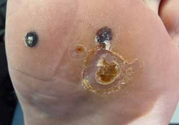 Treatment of Plantar Wart (During)